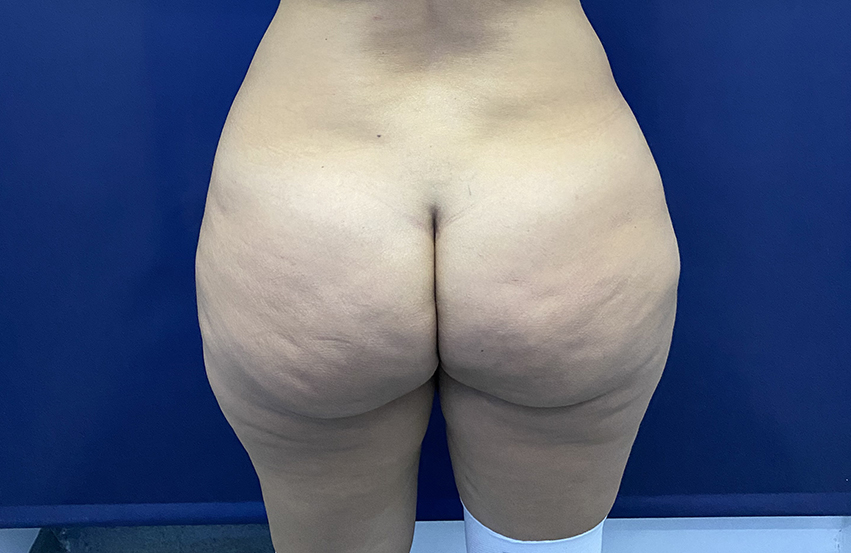 antes de gluteoplastia