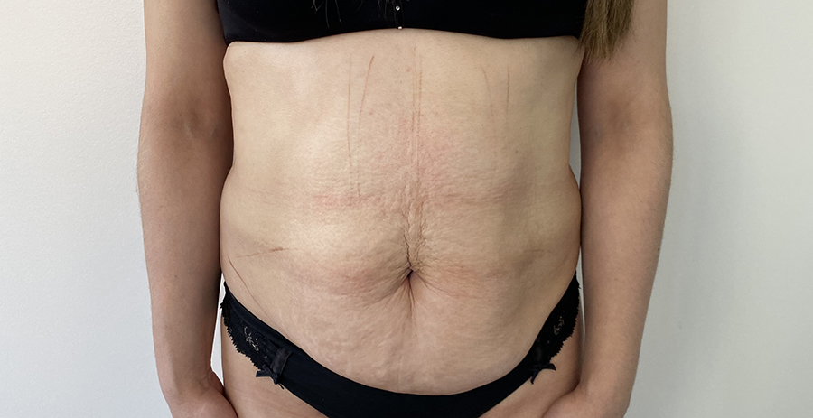 antes de abdominoplsatia