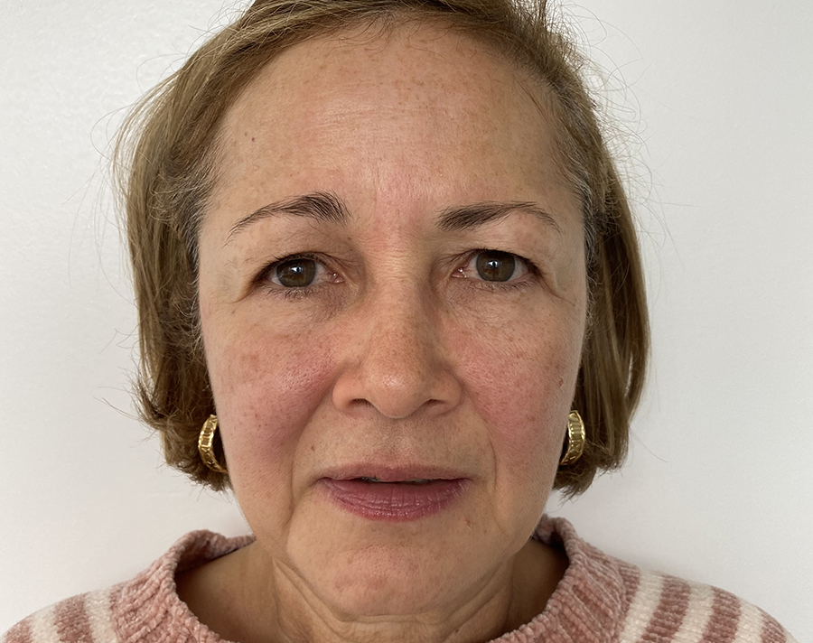 antes del lifting facial