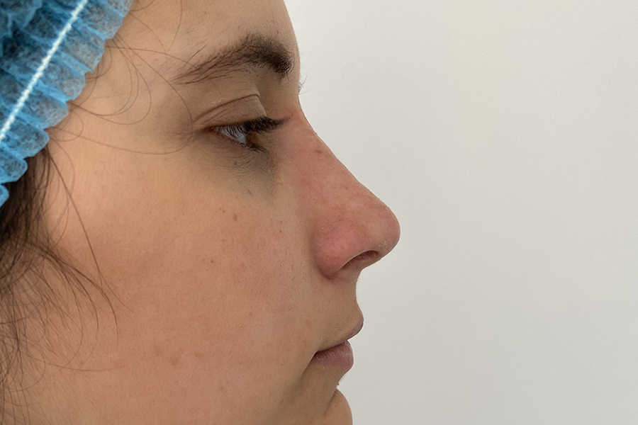 Después de una rinoplastia.