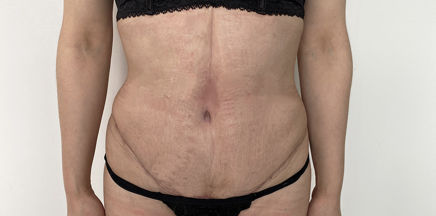 después de abdominoplastia