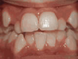 Crowding of the Teeth