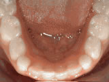non-braces treatment - after treatment