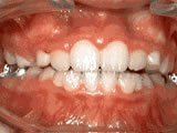 phase-one treatment - after treatment