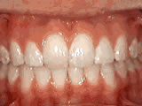 overjet - after treatment