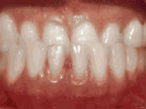 underbite