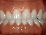 spacing of teeth - after treatment