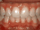 deep overbite - after treatment