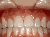 open bite - after treatment