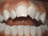 open bite
