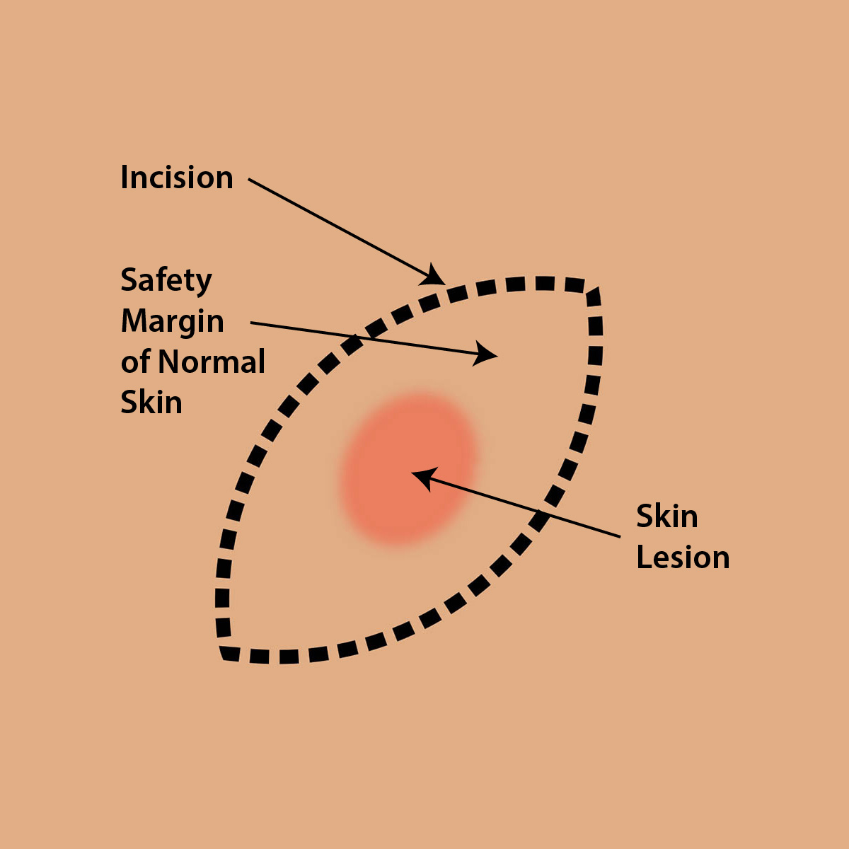 Glasgow Skin Cancer Clinic Excision of All Types of Skin Cancer