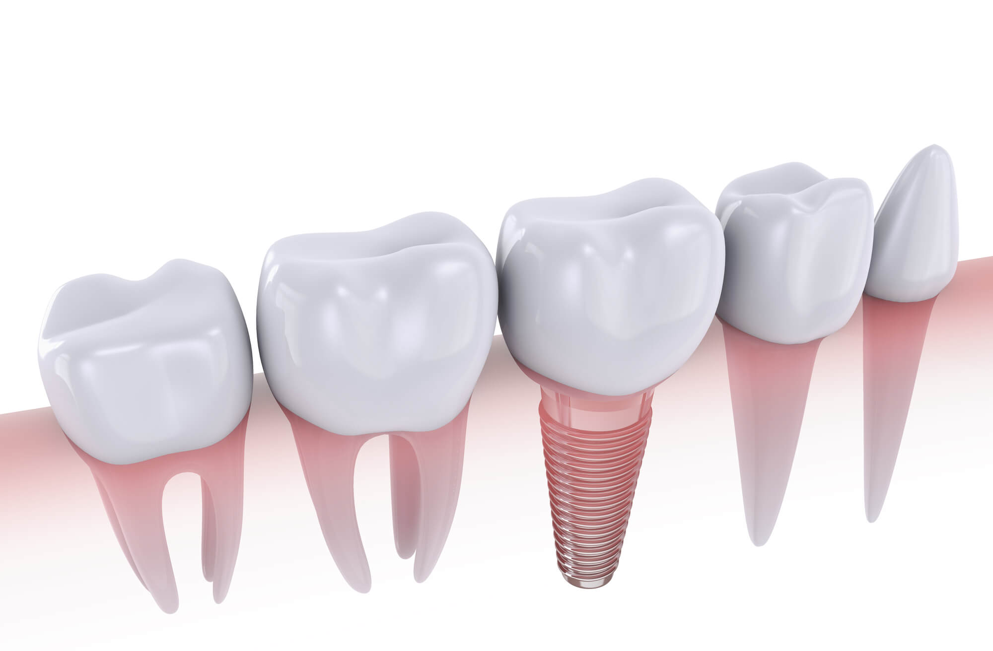 dental implants woodbury NY
