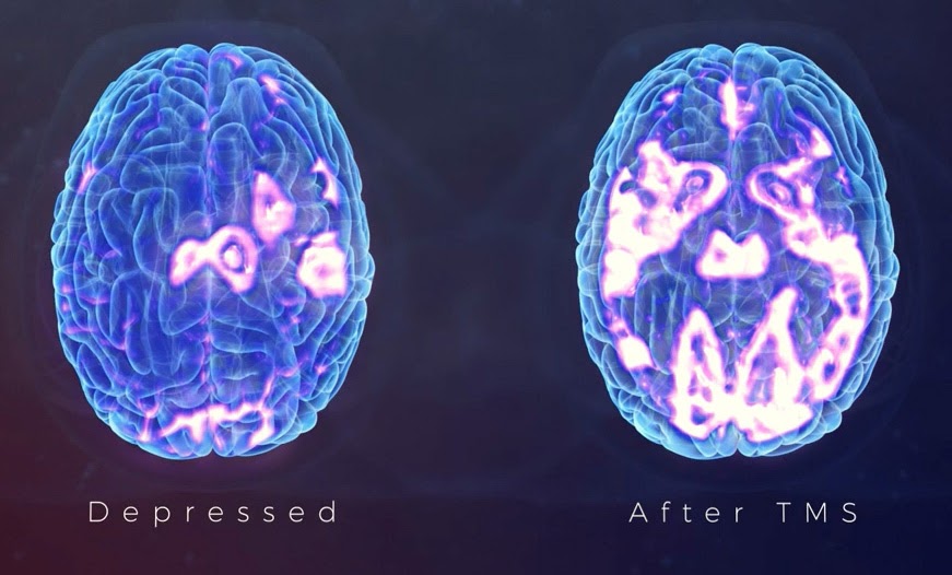 Brain scan images of the brain show the positive effects of TMS Treatment. The brain scan to the left shows the brain before TMS treatment and the brain scan to the right shows the brain after TMS treatment. Image courtesy of altapointe.org.