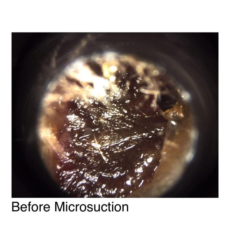 Syringing vs microsuction what’s safest for you and your ears? earLab