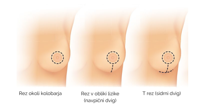 mastopeksija_dvig dojk_rez
