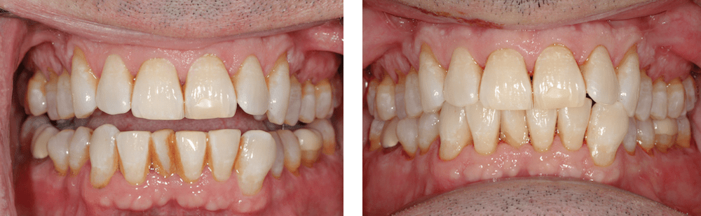 Deep cleaning (before) in Matthews, NC - Trailhead Advanced Dentistry