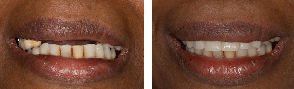 before and after - partial dentures in Matthews, NC - Trailhead Advanced Dentistry