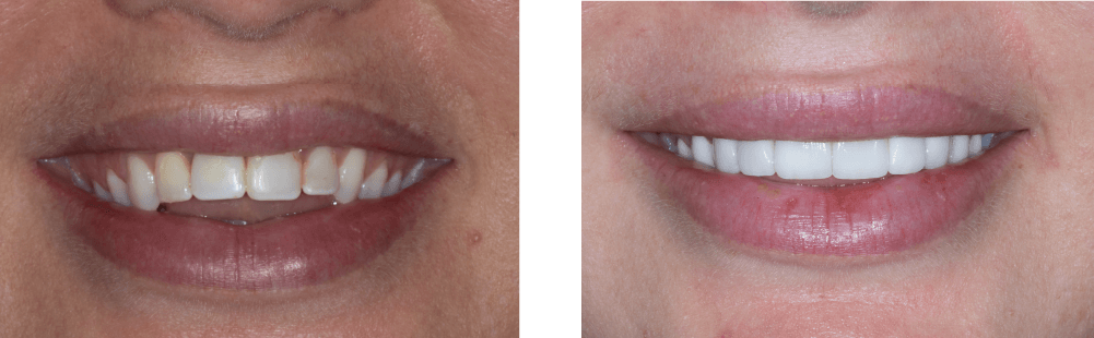 Dental veneer treatment before and after in Matthews, NC - Trailhead Advanced Dentistry