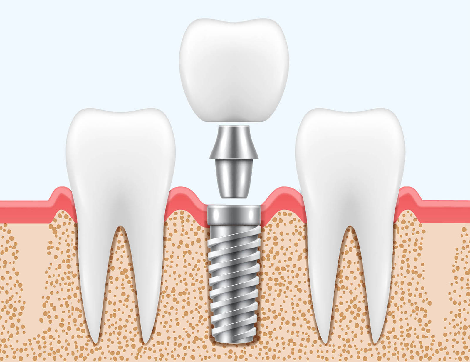 Dental Implants Clark & Watson Family Dental Practice Dentist in