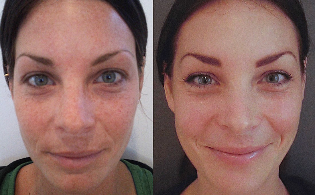 chemical peels before and after photos - cure for face blemishes