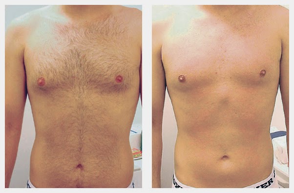 laser hair removal before and after photo - chest hair