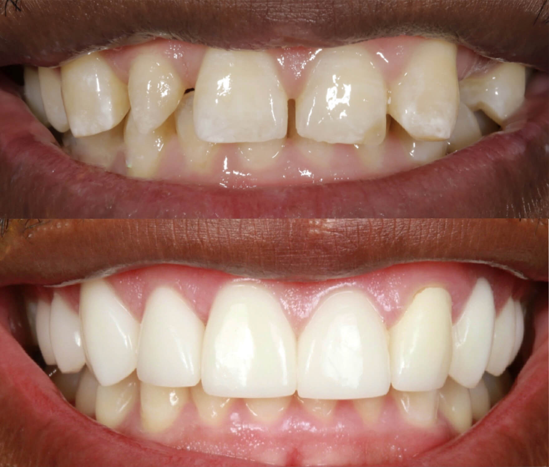 Porcelain Veneers in Denver, CO Southeast Denver Dental