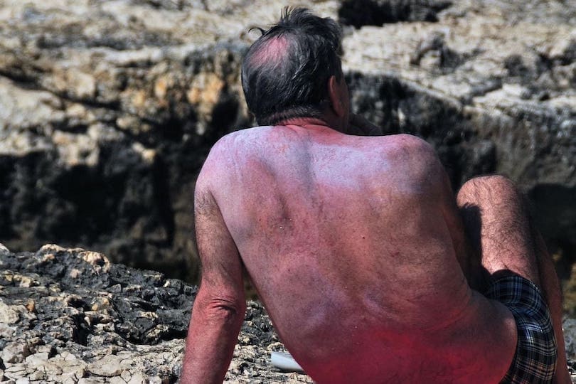 Sonnenbrand durch UV-Strahlung