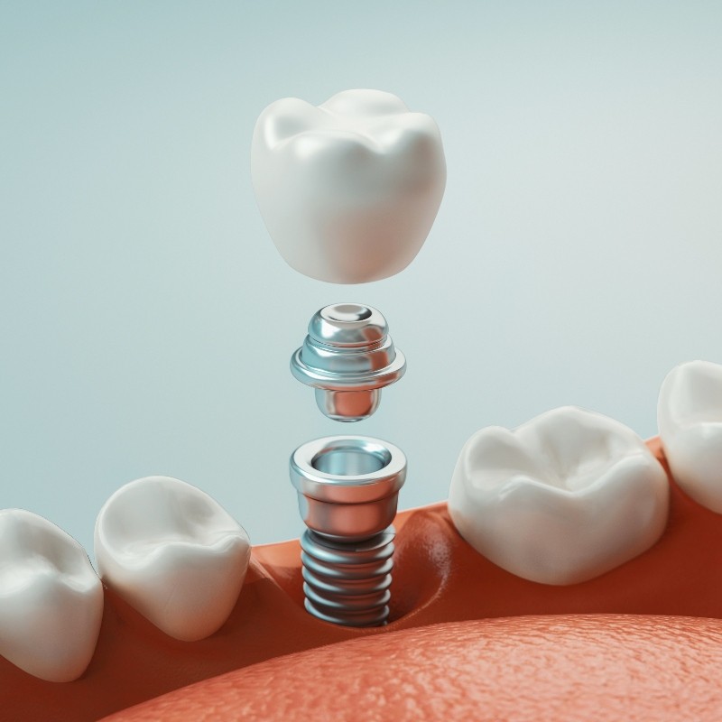 Upper Arlington Dental Implants Arlington Dental Group