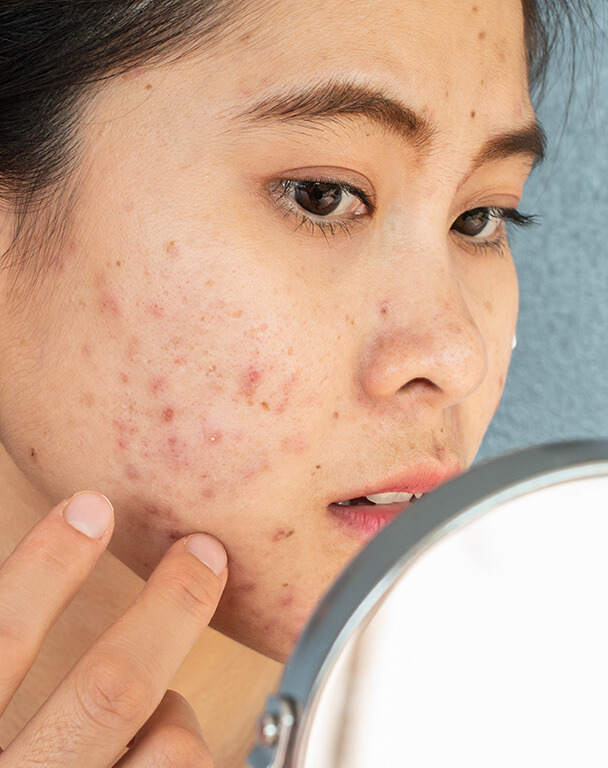Woman with acne on the cheeks looking at herself in the mirror