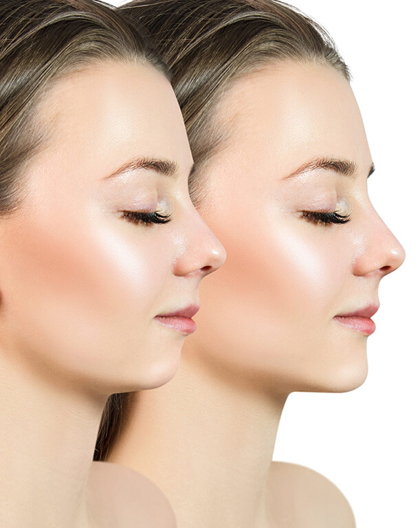 Before and After picture for Kybella