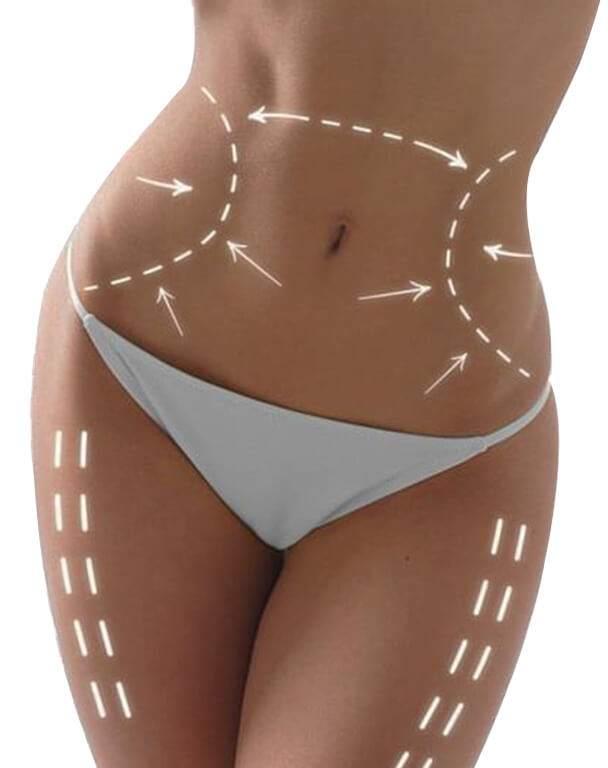 Woman's body with guide lines drawn for body contouring treatment