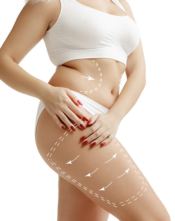 Woman's body with guide lines drawn for body contouring treatment