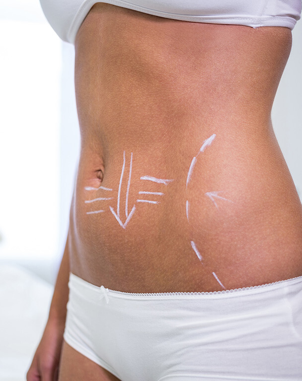 Woman's body with guide lines drawn for body contouring treatment