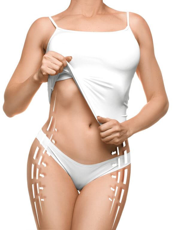 Slim woman wearing white underwear with liposuction areas marked on her body.