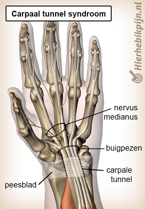 Carpaal Tunnel Syndroom PhysiqCare Encyclopedie