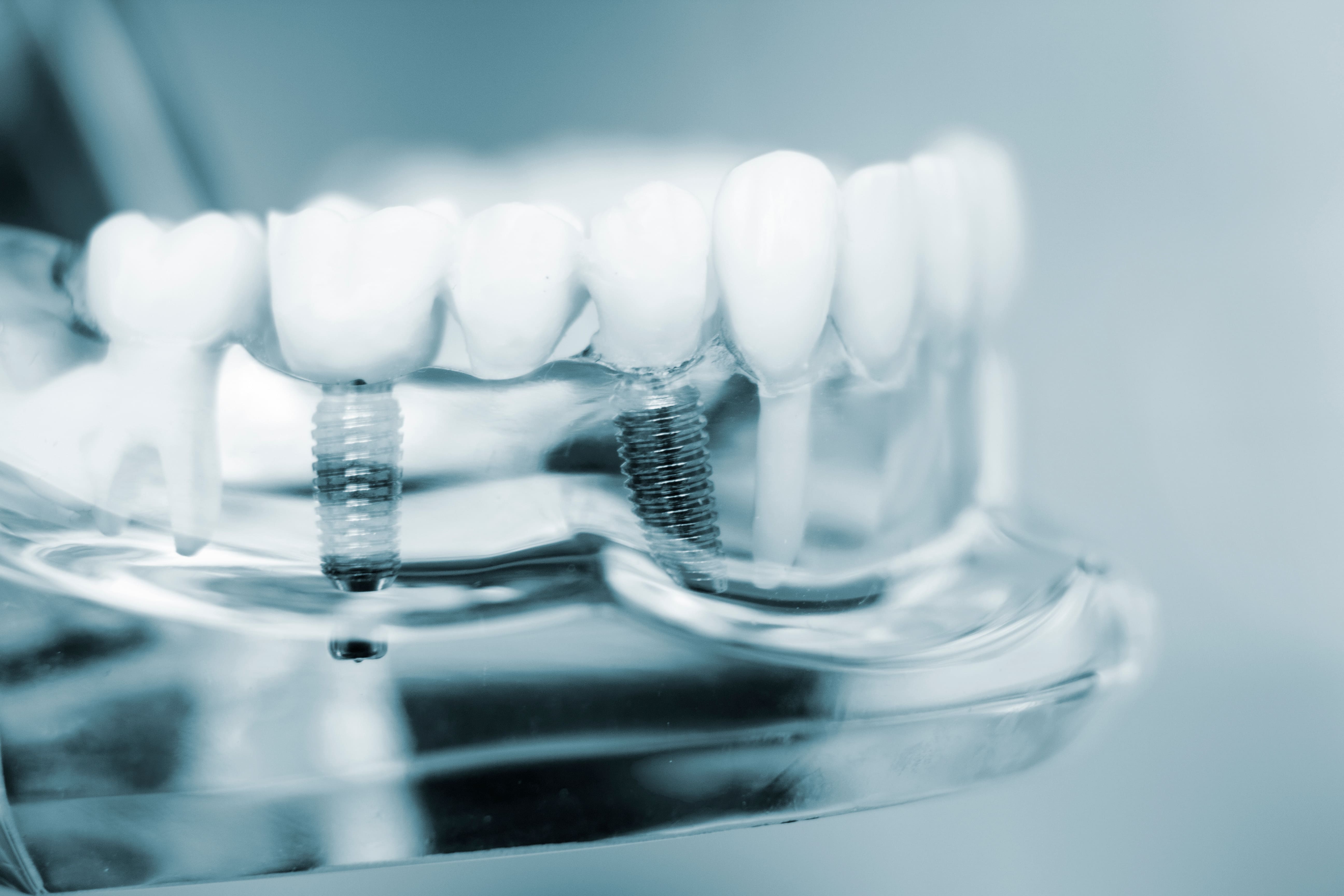 All-On-4 Dental Implants | Pasadena Periodontics