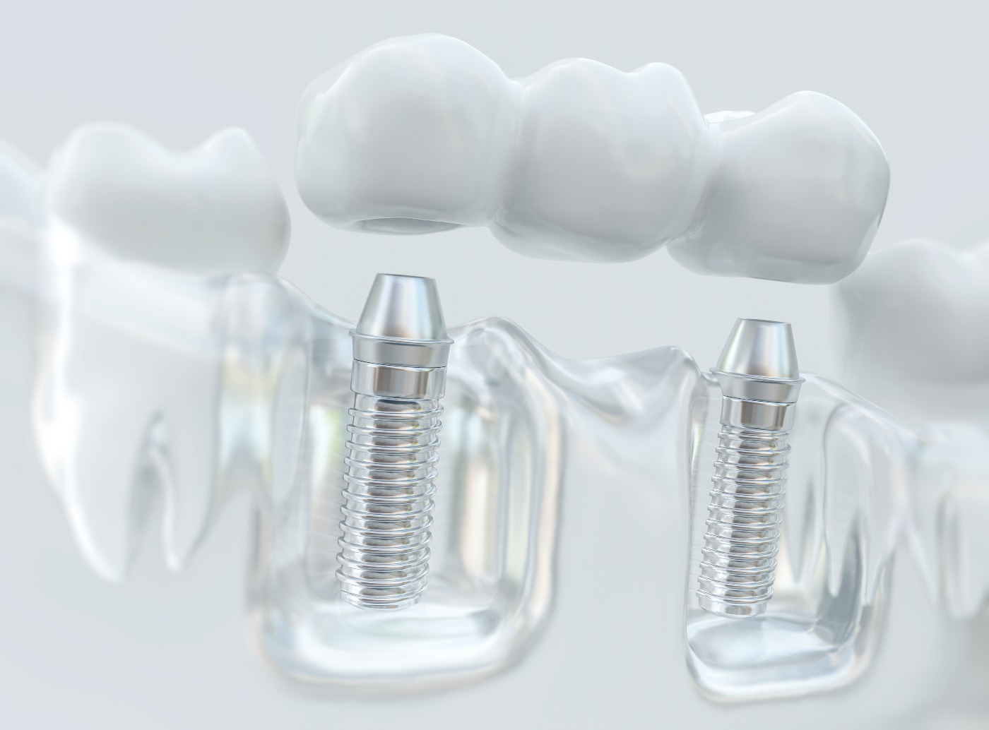 Dental Implants in Reno, NV Blue Water Dental Care