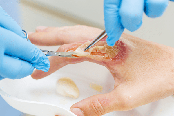 A burn victim receiving wound care