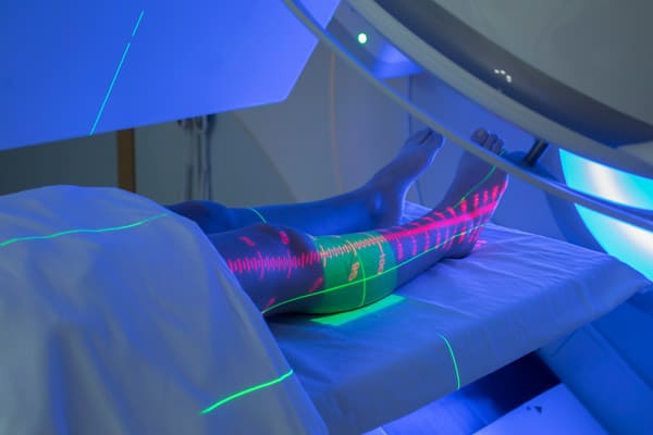 Patient Receiving Radiation Therapy for Sarcoma (Cancer) of the Leg
