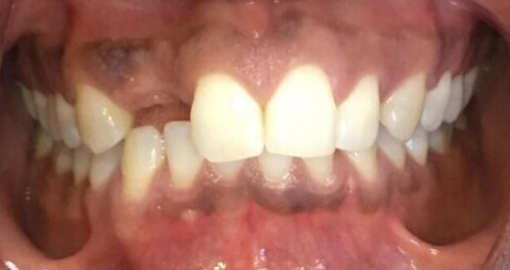 Before