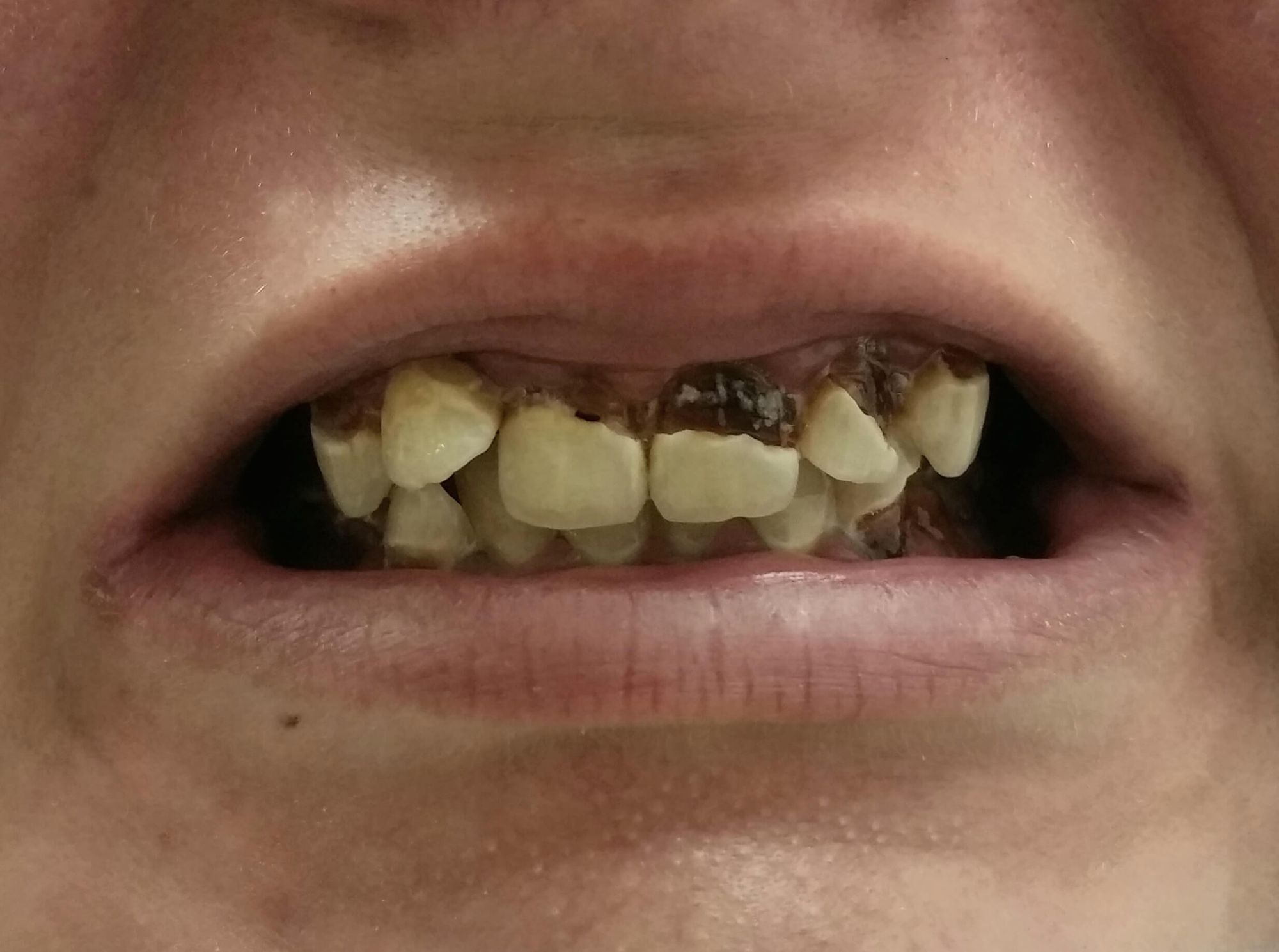 Veneers in Denver Central Family Smiles