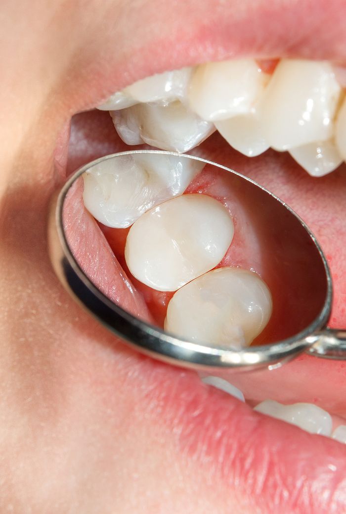 Dental Fillings in Zachary Z Dentistry