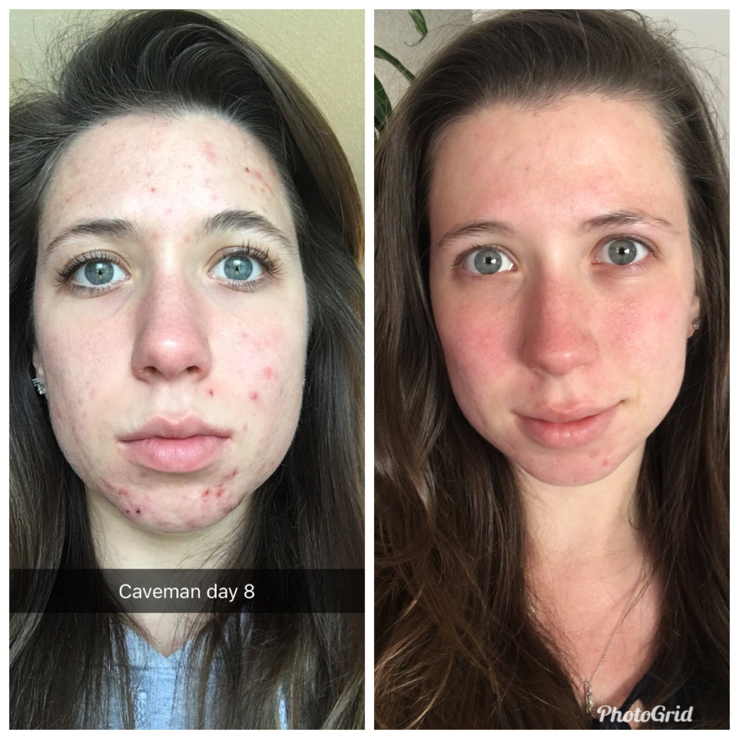 Left: February 2017; Right: May 2018Both pictures are without makeup (I'm wearing only mascara in the left picture) to show a fair comparison!