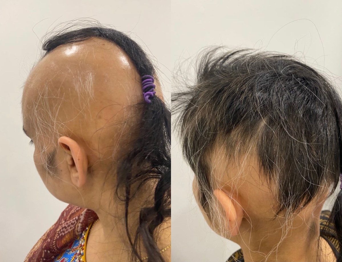 Hair Loss for Women Female hair loss Treatment