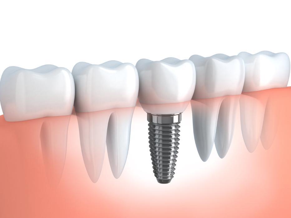 Illustration of dental implant