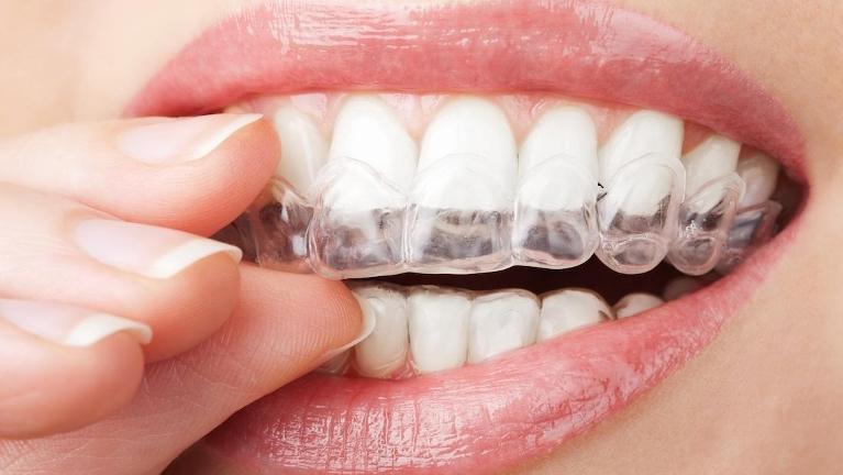 Woman putting in Invisalign | Huntsville AL Dentist