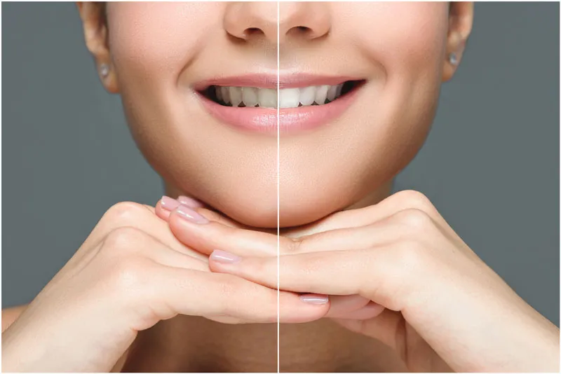 Before and after picture of a woman showing her perfect smile after a teeth whitening procedure.