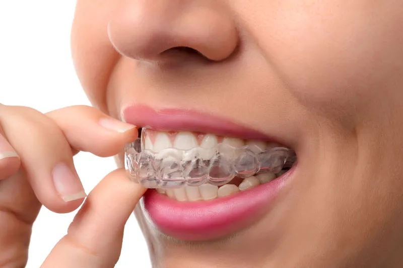 A woman wearing her clear braces.
