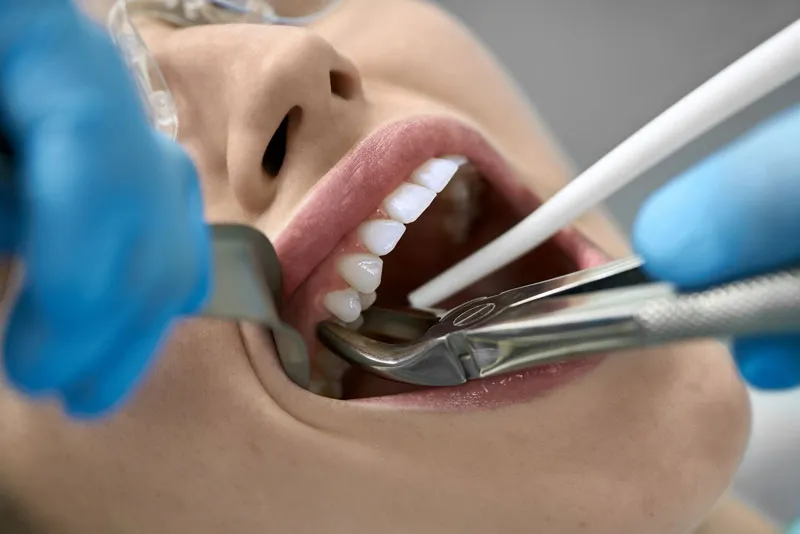 A patient getting his teeth removed with the help of a dentist.