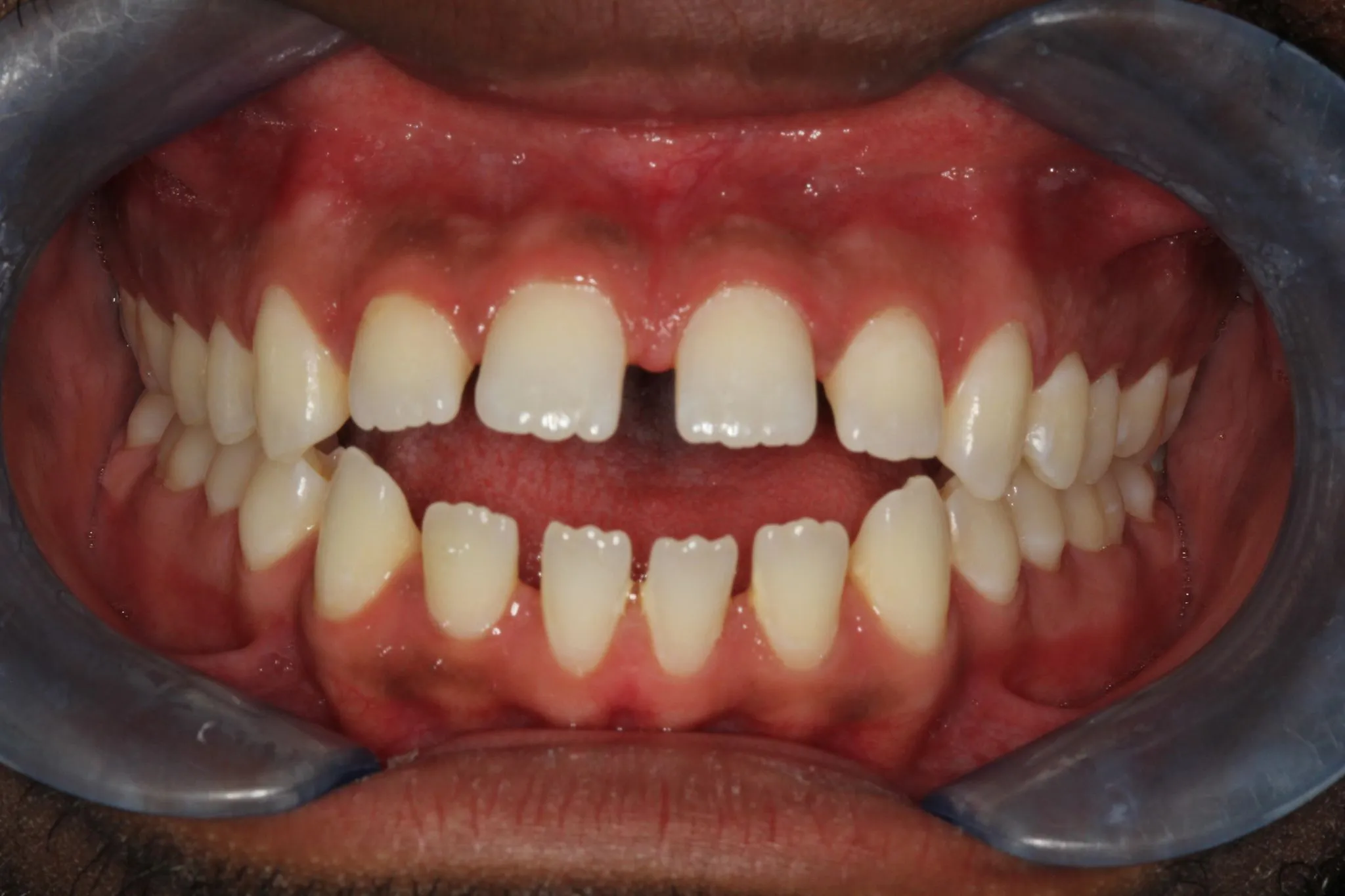 A close up of a mouth with multiple gaps on the teeth.